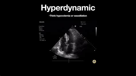 hyperdynamic lv|hyperdynamic heart syndrome in women.